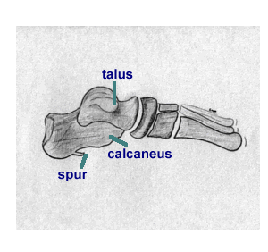 heelspur.gif (20606 bytes)